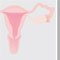 Grossesse ectopique