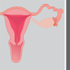 La grossesse ectopique