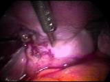 Infiltration de Pitressin