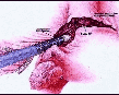 Hyst�rectomie (ablation de l'ut�rus) 
