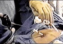 Introduction du Micro Laparoscope