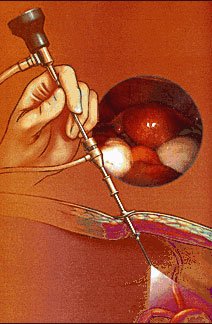 Micro-laparoscopie sous anesth�sie locale