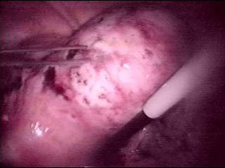 Le fibrome est cauth�ris�